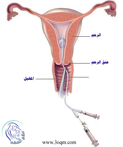 قسطرة أشعة الرحم الصبغية